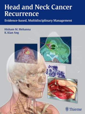 cover image of Head and Neck Cancer Recurrence